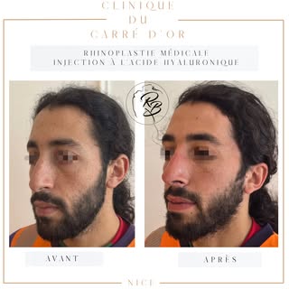Harmonisation du profil grâce à la rhinoplastie médicale ✨

Grâce aux injections d’acide hyaluroniqu