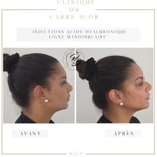 ✨ Redéfinissez votre Jawline avec l’acide hyaluronique ✨

Envie d'un visage plus structuré et d'une 