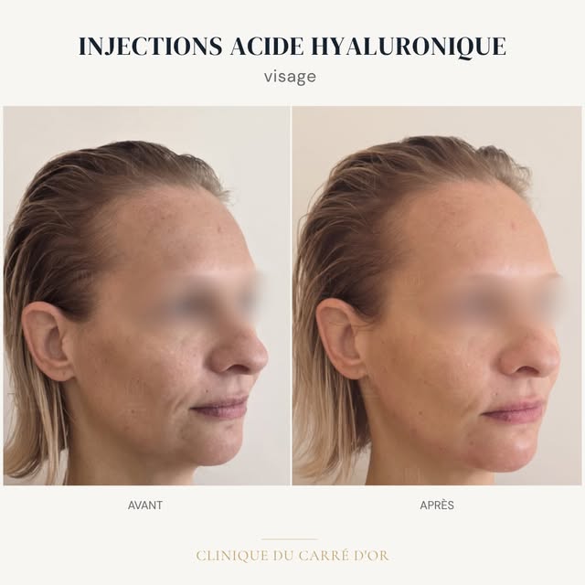 Avant / Après - Acide hyaluronique ✨

Un résultat pensé pour préserver l’harmonie du visage tout en 