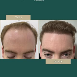 ✨ Resultado de 10 meses pós-transplante capilar ✨ 

Cada grande resultado começa muito antes da ciru
