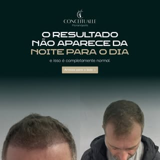 Um dos maiores desafios após o transplante capilar é controlar a ansiedade. 💆‍♂️

Muita gente acred