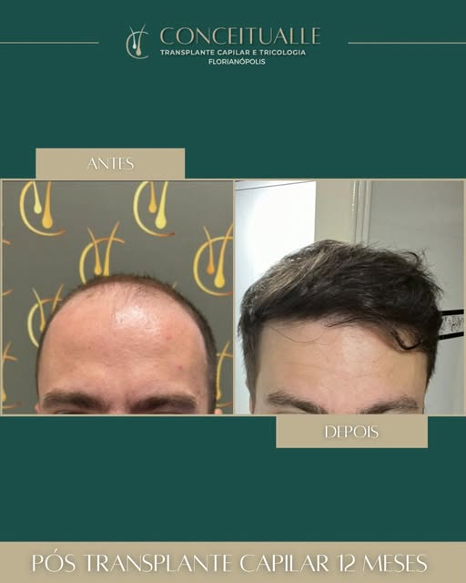 ANTES x DEPOIS | 1 ANO DE EVOLUÇÃO 🤩

Um resultado que representa muito mais do que um transplante 