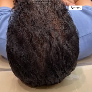 Calvície tem tratamento! 

#calviciefeminina #alopecia #calviciemasculina #calviciefeminina