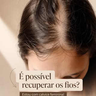✨Na alopecia androgenética feminina, o fio vai ficando cada vez mais fino, curto e frágil. 

✨Com o 