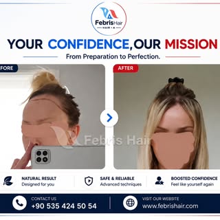 #hairtransplantantalya #haartransplantationantalya #sacekimantalya #dhi #haartransplantation