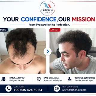 #haartransplantantalya #hairtransplantantalya #antalyasaçekimi #haartransplantationantalya
