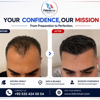 #hairtransplantantalya #haartransplantationantalya #haartransplantation #dhi