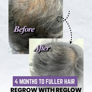 From Hair Loss to Hair Confidence — In Just 4 Months! 💪✨
Meet our patient who came to Reglow Skin &