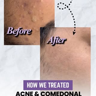 Acne & Comedonal Congestion? We’ve Got It Covered! ✨
This patient came to Reglow Skin Clinic with ac
