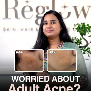 Worried about adult acne? It’s never too late for clear skin. 

Adult acne can be frustrating — stub
