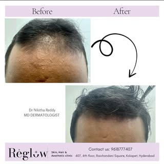 Real Patient Result | GFC Hair Regrowth 🌟
Hair thinning or receding hairline?
Here’s a powerful Bef
