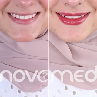 لما تكون الشفايف صغير جداً بصير عندنا Rolling Lips يعني الشفايف بتميل للداخل اكتر وبتبين اللثة اكتر 