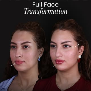 A little contour goes a long way 😍 Subtle lower-face enhancement for cleaner contours and a more ba