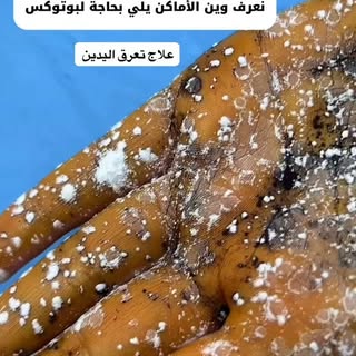 ⁨	باستخدام البوتوكس رح نتخلص من تعرق اليدين ✨ اجراء سهل وبسيط بالعيادة ويدوم من ٦-٤ اشهر ✨
#تجميل #b