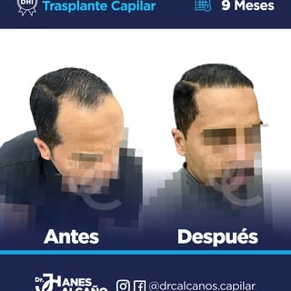 El tiempo también forma parte del tratamiento. 👉🏻

A los 9 meses, este paciente muestra una evoluc