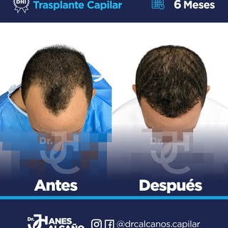 A tan solo 6 meses del trasplante capilar, nuestro paciente muestra una notable recuperación de la d