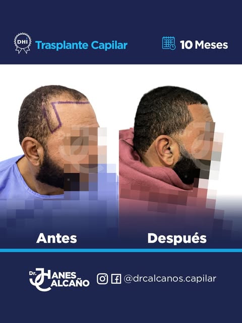 A 10 meses de su trasplante capilar, nuestro paciente muestra una evolución favorable, con una línea