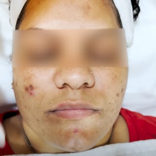 Say Goodbye to Post-Acne Hyperpigmentation! 

Dealing with stubborn post-acne dark spots? 🛑 Watch o