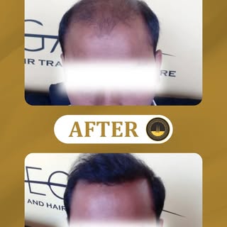Still wondering if a hair transplant really works? The results speak for themselves. 👆

At Regain S