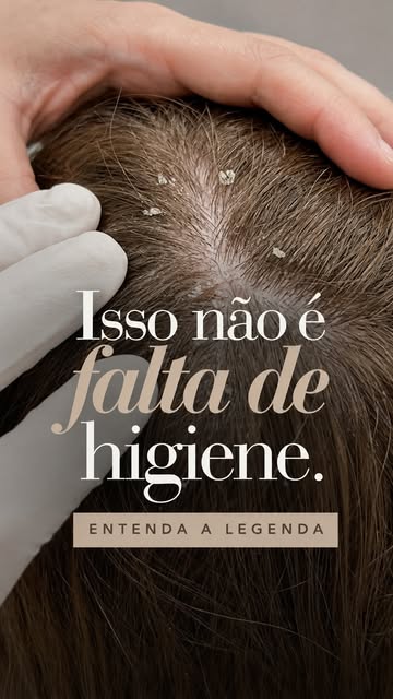 Isso não é falta de higiene.

Quando o couro cabeludo apresenta descamação frequente, oleosidade, co