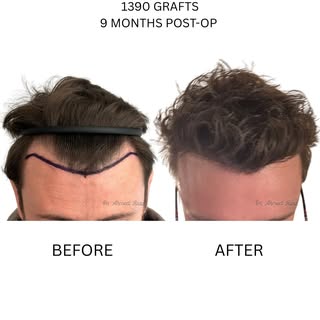 One of my favourite parts of this job is reviewing patients after a hair transplant — and it isn’t e