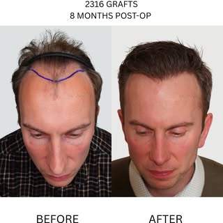 A well executed hair transplant can have a significant impact on the way the face is framed.

This c
