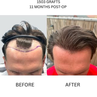 Another incredible transformation.

The vision was to restore and refine the hairline without it obv