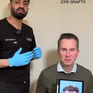 This case demonstrates just how much of an impact a hair transplant can have on the framing of the f