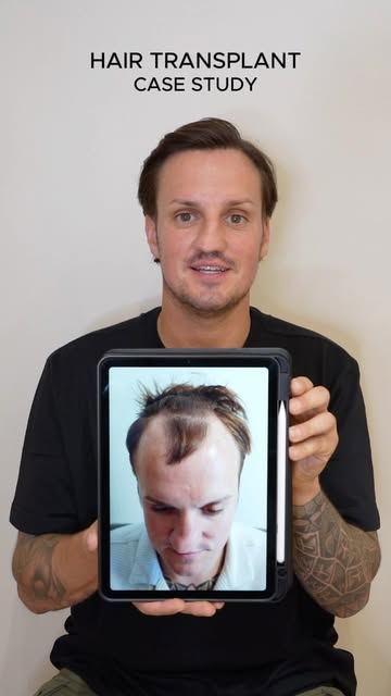 A huge transformation, built around the small details.

Jordan underwent just over 3,000 grafts acro