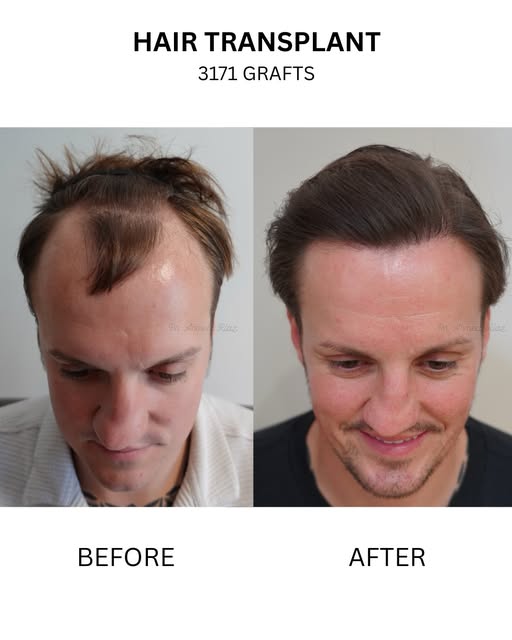 One of my favourite results to date.

3,171 grafts across two surgical sessions, meticulously planne
