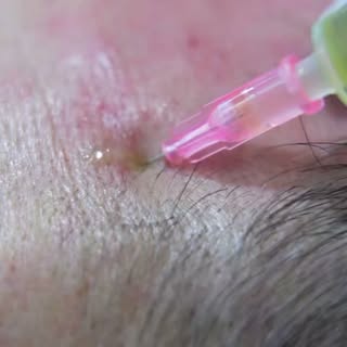 PRP vs. PRF for Hair Restoration 🌱

PRP = concentrated platelets + growth factors.
PRF = platelets 
