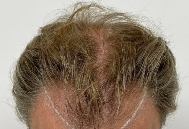 You didn’t choose to lose your hair but you can choose to get it back with  Neograft. 

#Delaware #h