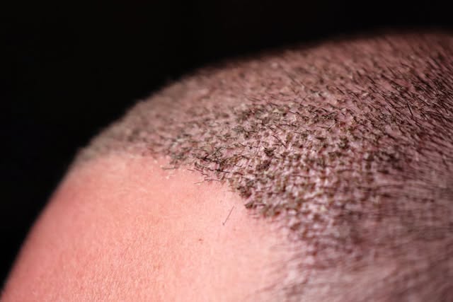 Post-procedure close-up 👀 All grafts in place. Now, let the growing begin! 🌱

#NeoGraft #HairTrans