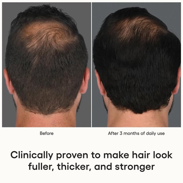 Plated Skin Science hair serum has been showing good results at Delaware Hair Restoration and is inc