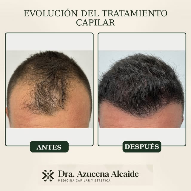 Individualizar cada tratamiento: 
Paciente que, tras indicar unos meses tratamiento oral y mesoterap
