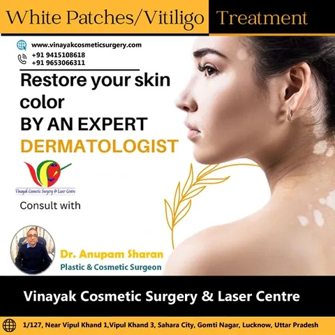 Treatment for vitiligo often involves topical corticosteroids to help repigment the affected skin an