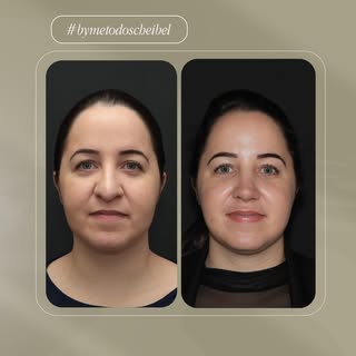 Antes da rinoplastia, eu convivia com uma insegurança muito grande comigo mesma. O espelho era um lu