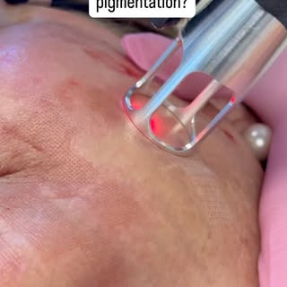 You’re ready for UltraClear! 

The time to experience the latest and greatest 🙌🏽 in ablative laser