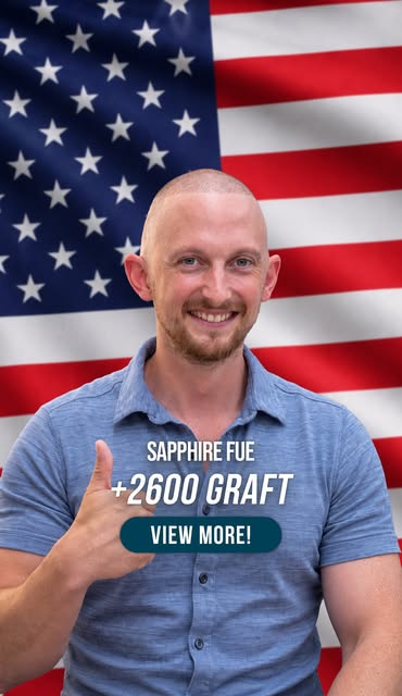 When trust brings patients back for full coverage 🎙️💎

First the hairline, now the crown! 2600 Sap