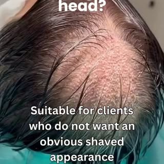Hair transplant without shaving your head? 👀
With Non-Shave FUE, there is no need to shave the dono