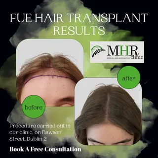 Female hair loss deserves its own approach. ✨

This before & after shows a beautifully restored fema