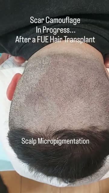 FUE donor area still looking visible? 👀

Scalp Micropigmentation can help reduce the contrast betwe