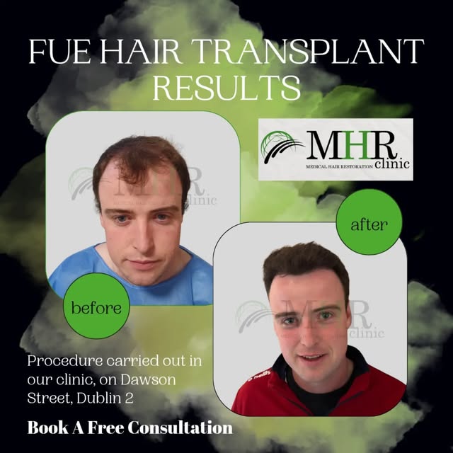 From thinning at the front to a fuller, natural-looking hairline. 👏
This FUE Hair Transplant result