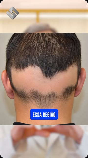 A Alopecia Areata Ofiásica é uma situação desafiadora, pois geralmente é mais refratária ao tratamen