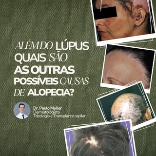 O lúpus é uma causa conhecida de alopecia. 

Porém, é importante ter em mente que diversas outras do