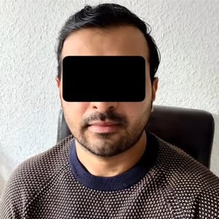 Hair Transplant by Dr Burhan Ashraf 0092 308 1423186 
#hairtransplant #hairtransplantsurgeon #hairre