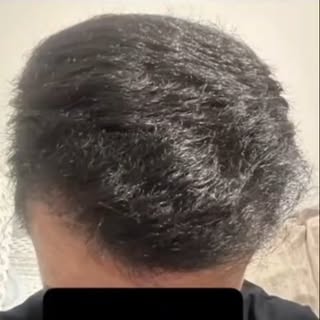 Hair Transplant by Dr Burhan Ashraf #foryou #viral #hairtransplant #drburhan #wbesthetique