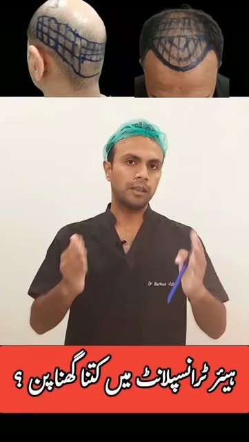 Hair Transplant by Dr Burhan Ashraf #foryou #viral #hairtransplant #drburhan #wbesthetique