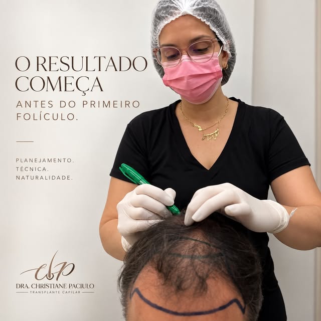 O resultado de um transplante capilar começa muito antes da implantação dos fios. ✨

Cada detalhe do