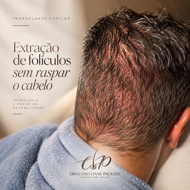 Nem todo transplante capilar precisa começar raspando o cabelo. ✨

Neste caso, realizamos a extração